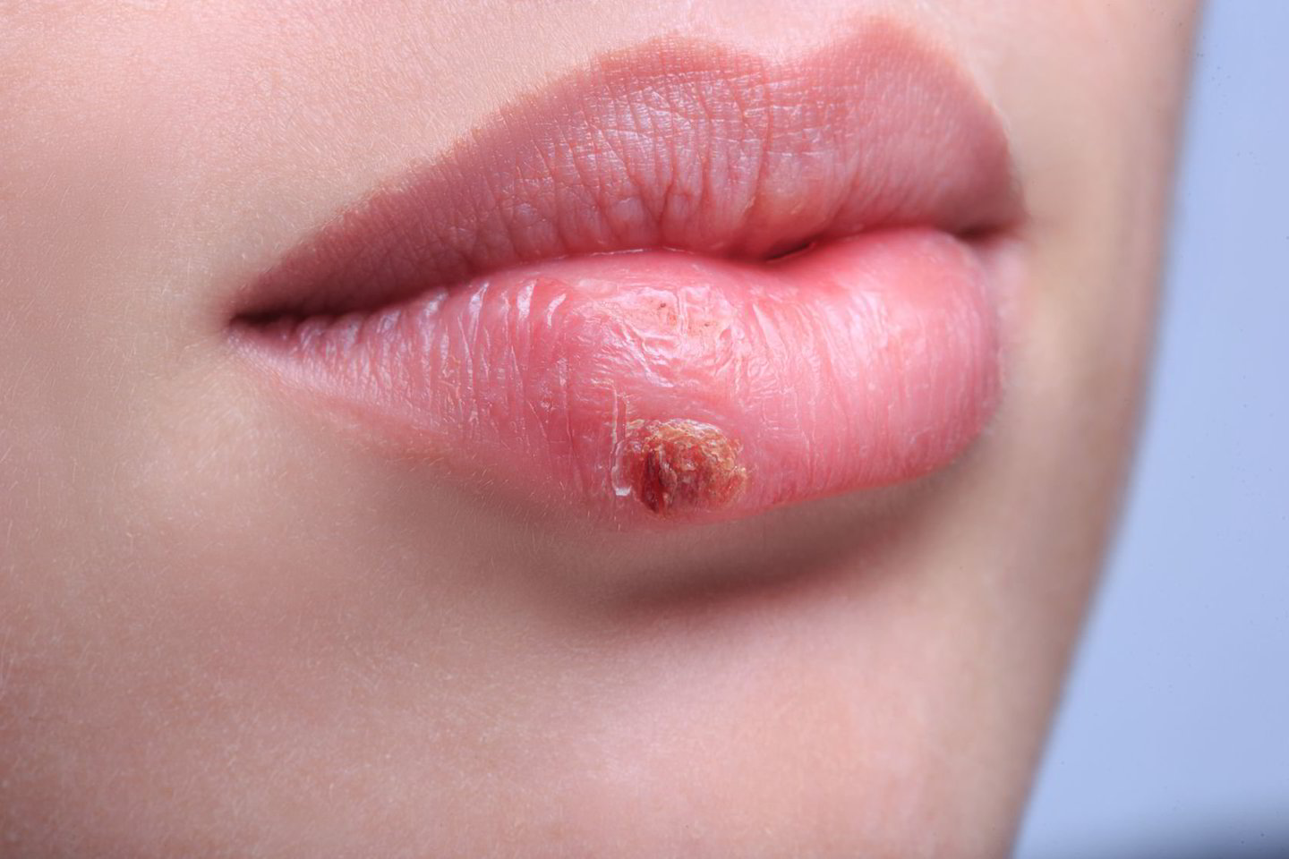  Dažniausiai pasitaikanti infekcija herpes infekcijų grupėje – paprastoji pūslelinė, kurios labiausiai matomas požymis – ant lūpos iškilusios pūslelės, vėliau virstančios šašais.<br> 123rf.com nuotr.