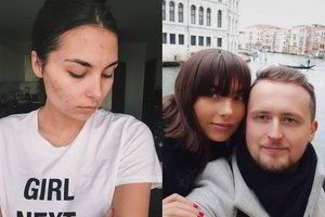 Manto Katlerio mylimoji Aistė atskleidė, kaip sunkiai kovoja su akne