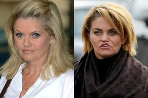 Plastinės operacijos atėmė sveikatą, tačiau aktorė nebegali sustoti 