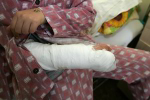 Reabilitacija po lūžių – tolesnis žingsnis į gyvenimą