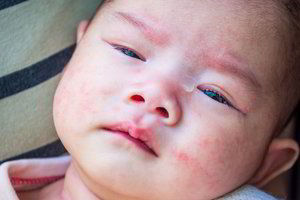 Pavasario įtaka odai: atopinio dermatito pažeista oda atvira infekcijoms