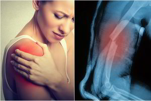 Itin reta kaulų nykimo liga užminė gydytojams didžiulę mįslę