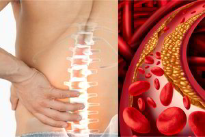 Užsikimšusios kraujagyslės ir nugaros skausmai: tik pora šio įpročio pasekmių