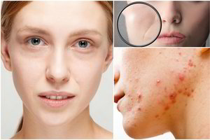 Kankina spuogai, tamsūs paakiai? Gali būti, kad iškilo pavojus sveikatai 