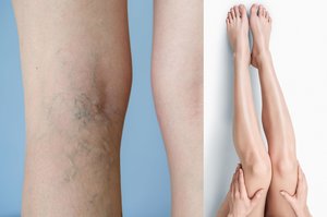 Naudingi patarimai: padėkite kraujagyslių tinklo subjaurotoms kojoms