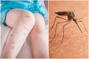 Nemaloni tiesa, kodėl niežti uodų įgėlimų vietas – tai jums nepatiks