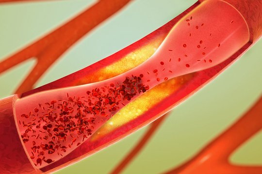 Padidėjęs cholesterolis šienauja gyvybes. Štai ką reikia žinoti