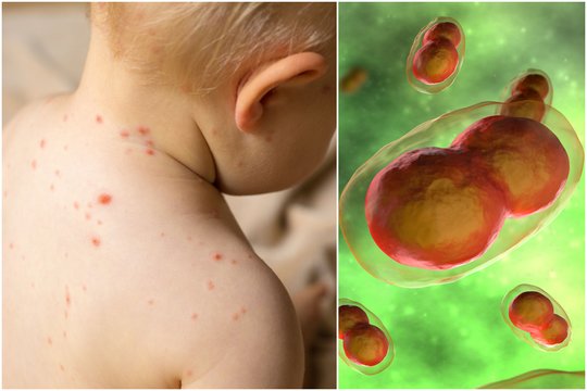 Reta užkrečiamąja liga susirgusio berniuko šeimai diagnozė sukėlė siaubą