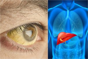 Svarbu žinoti: 6 požymiai, įspėjantys apie kepenų veiklos sutrikimą