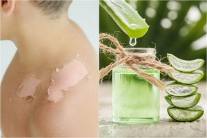 Dermatologė patarė, kaip nudegus saulėje sušvelninti skausmą