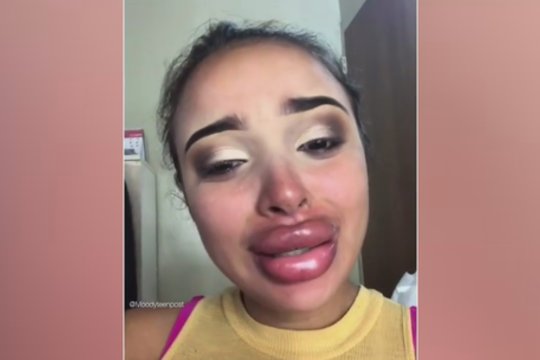 Grožio injekcijų košmaras: putlių lūpų norėjusi mergina nebežino, ko griebtis