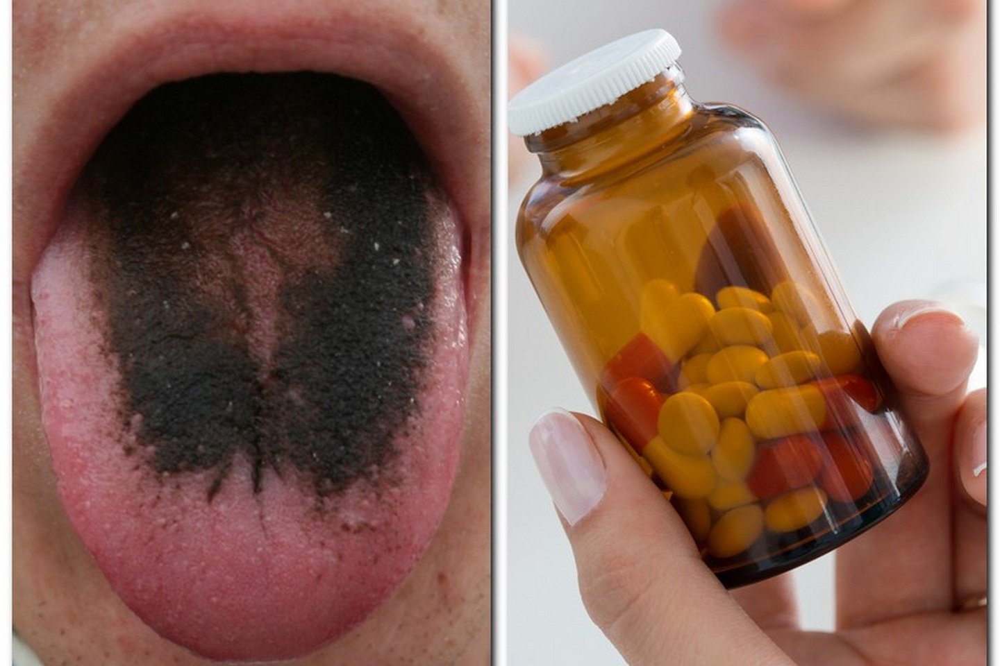  Keistas šalutinis vaistų poveikis vadinamas juodu „plaukuotu“ liežuviu.<br> Wikipedia ir 123rf nuotr. 