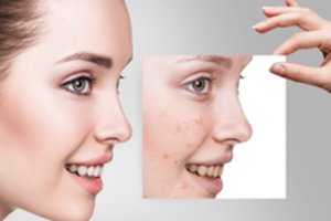 Veido spuogai liks užmaršty, tereikės atsisakyti kelių dalykų