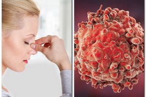 Šios piktybinės ligos diagnozę kasmet išgirsta 500 lietuvių: apie ją įspėja nuovargis