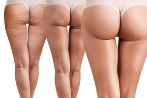Kova su celiulitu: efektyviausios priemonės paprastesnės nei manėte