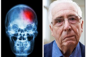 Neurologas išvardijo svarbiausius insulto požymius: juos pastebėję nedelskite