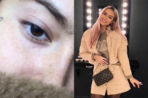 Karolina Meschino ryžosi neįprastai procedūrai: padailino veidą