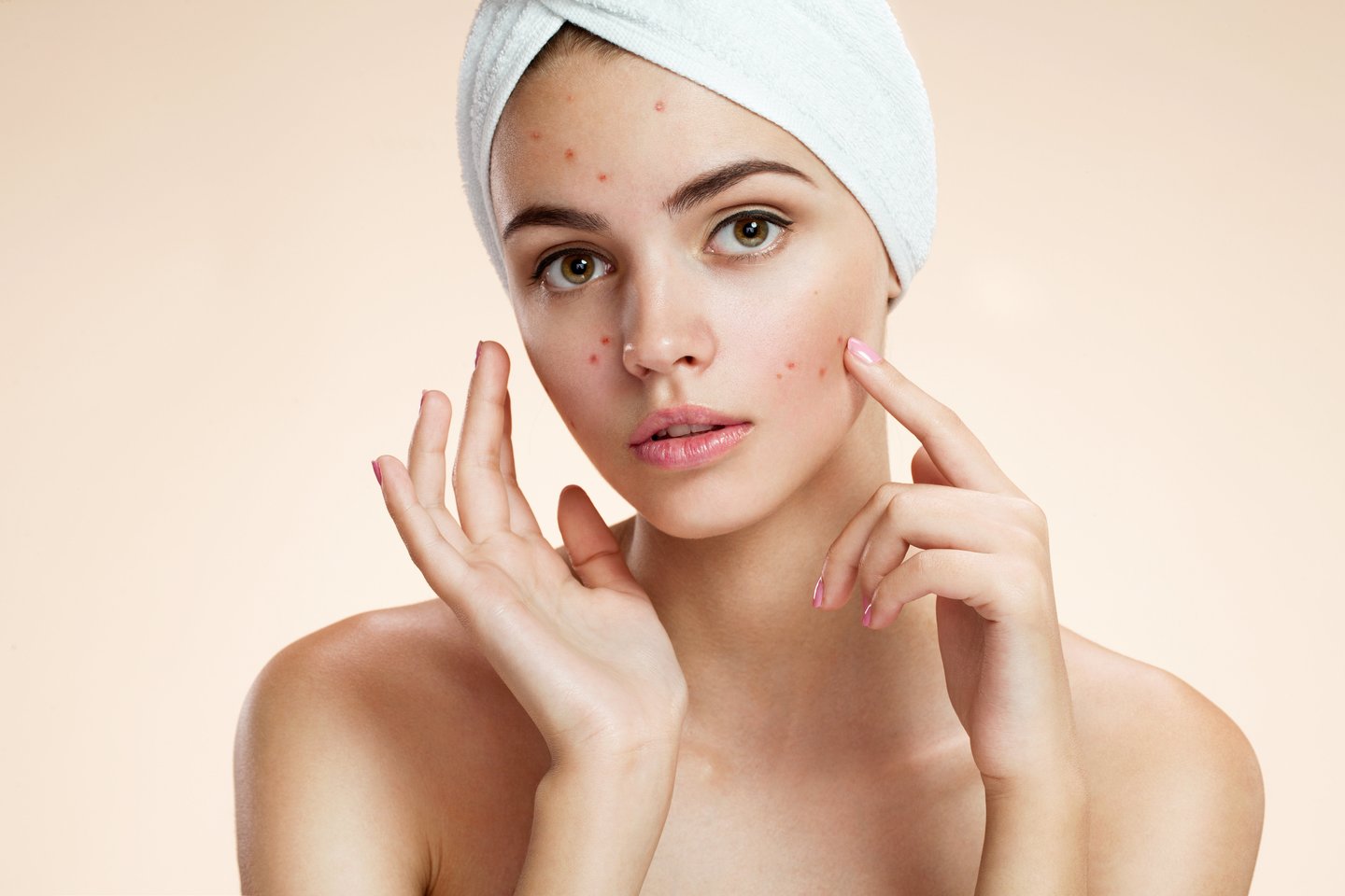 Dažniausiai aknė pasireiškia bėrimu ant veido, krūtinės ir nugaros odos.<br> 123rf nuotr. 