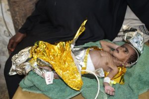 Jemene nuo bado galėjo mirti 85 tūkst. vaikų, sako pagalbos organizacija