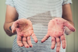 Paaiškėjo, kaip Visagine išplito tymų infekcija