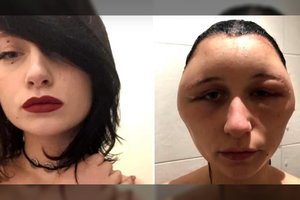 Po populiarios grožio procedūros deformavosi veidas: įspėjo ir kitus