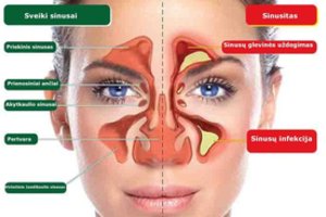 Peršalimas slepia sunkesnę ligą: netinkamai gydoma gresia komplikacijomis