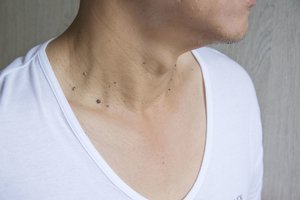 Paprastas būdas, kaip atsikratyti papilomų