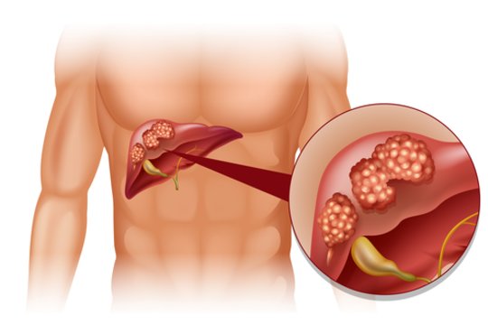 Specialistai įspėja: net mažas šios medžiagos kiekis gali sukelti kepenų vėžį