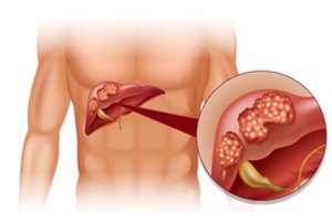 Specialistai įspėja: net mažas šios medžiagos kiekis gali sukelti kepenų vėžį