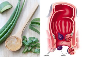 Vaistas nuo hemorojaus greičiausiai auga ant jūsų palangės