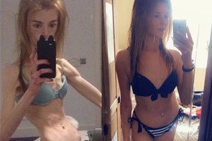 28 kilogramus svėrusiai moteriai išsigelbėti nuo mirties padėjo vienas produktas