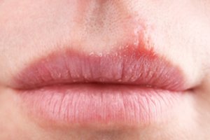 Sausos ir šerpetojančios lūpos išduoda, kuo sergate