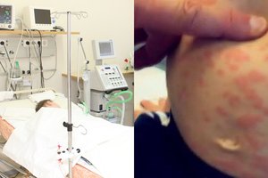 Į Lietuvą sugrįžo išnaikinta liga: vaistų nėra, komplikacijos gali baigtis mirtimi