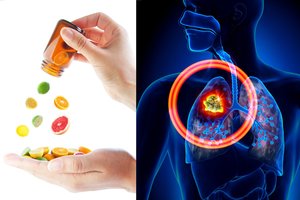 Įrodyta tyrimais: šie vitaminai trukdo augti tam tikrų rūšių vėžiui