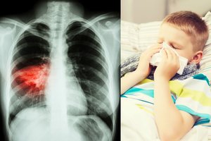 Tuberkulioze susirgo 30 vaikų, iš kurių vienas – atvira forma