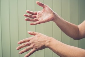 Lietuvoje netikėtai didelis tymų protrūkis: patarė, ką daryti susidūrus su sergančiu