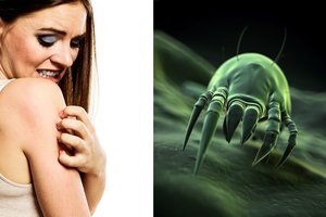 Pūslės ant odos nebūtinai reiškia alergiją: kaip atpažinti naminių parazitų įkandimus?