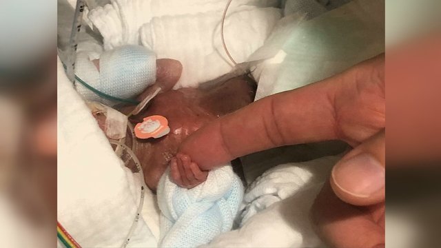 Stebuklas įvyko: gydytojai išsaugojo mažiausio pasaulyje kūdikio gyvybę 