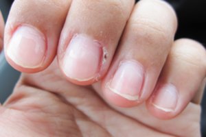 Atsargiai – lūžtantys nagai signalizuoja apie rimtus negalavimus 