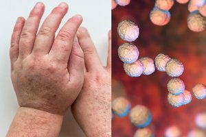 Į Angliją sugrįžo baisios Viktorijos laikų ligos: įspėja ir lietuvius