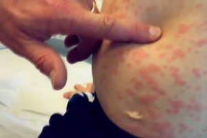 Sparčiai plinta: sveikatos specialistai aiškinasi, kaip suvaldyti sunkios ligos protrūkį 