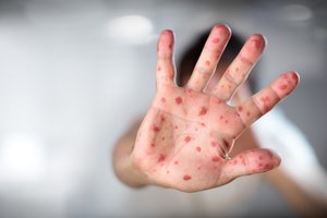 Kauno apskrityje didžiausias per kelis dešimtmečius tymų protrūkis