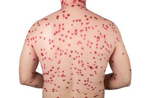 Reiškęs abejones dėl skiepų politikas susirgo vėjaraupiais ir pateko į ligonę