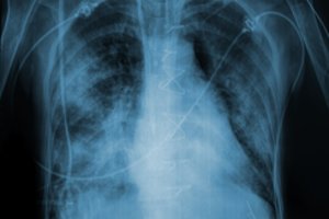 Pranešė viltingą žinią: mirtinai pavojinga liga gali būti visiškai išnaikinta