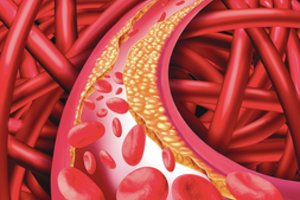 Šiai pacientų grupei kraujotaka reikia rūpintis ypatingai