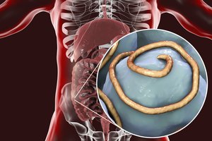 Paauglį pražudė kiauliena: organizme įsiveisė parazitai