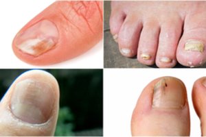 Nagų pokyčiai išduoda rimtas ligas: suskubkite pasitikrinti