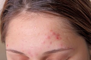 Devyniolikmetė negali ramiai pažiūrėti į veidrodį: veidą išbjaurojo įkyri liga