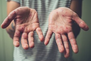 Socialinės apsaugos ir darbo ministerijoje – tymų atvejis: susirgo darbuotojas, imtasi priemonių