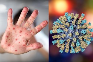 Štai ką privalote žinoti, jei turėjote kontaktą su tymais sergančiu asmeniu